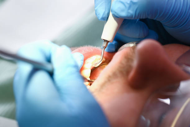Best Emergency Wisdom Teeth Removal in Squirrel Mountain Valley, CA