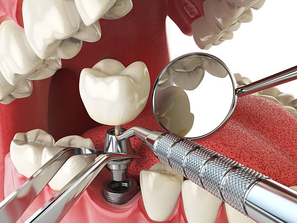 Best Emergency Treatment for Dental Infections or Abscesses in Squirrel Mountain Valley, CA